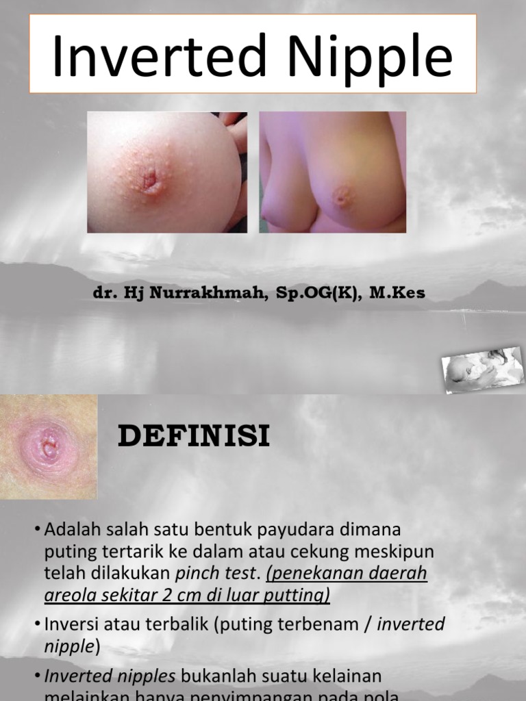 Inverted Nipple Meaning