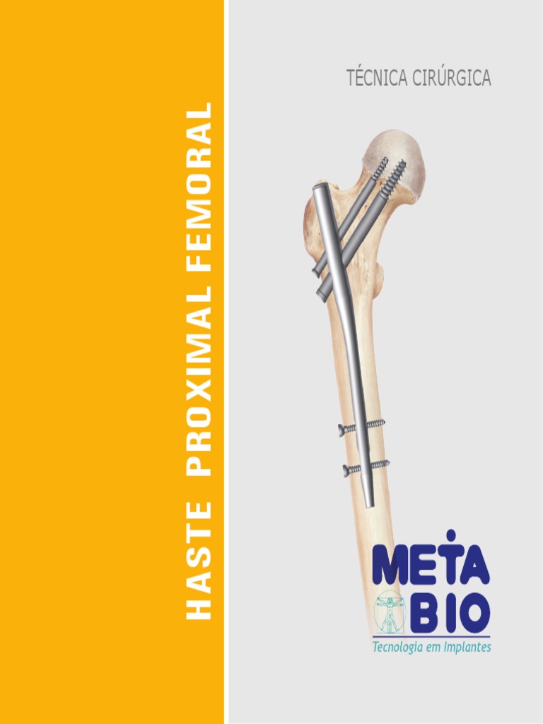 Distal Tibial Fracture,DTN Distal Tibial Nail ,Medical Device Manufacturers  -Double Medical, image size:768x1024