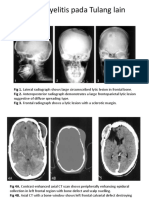 394671219 Gambaran Radiologi Osteomielitis
