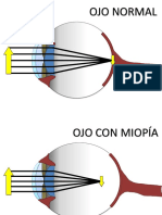 OJO Miopia Hipermetropia Normal