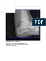 Ankle Achilles Ossification