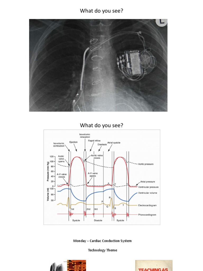 Pacemaker Heart 2.0 Heart Valve Diastole