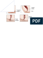 Prolapso Rectal