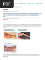 Celulite - Distúrbios Dermatológicos - Manuais MSD Edição para Profissionais