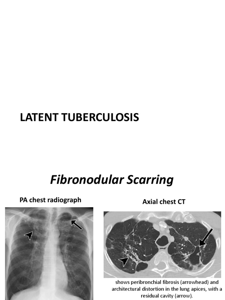 TB Radiology | Download Free PDF | Tuberculosis | Health Sciences