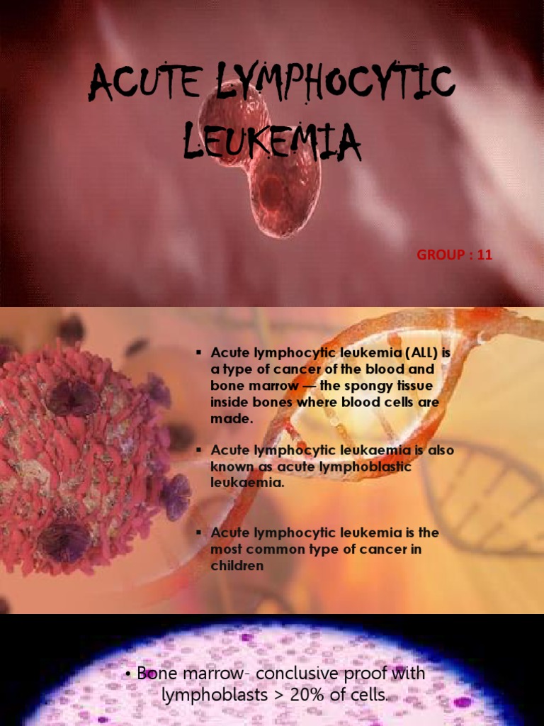 Curated visual reference: Visual Reference: Understanding Acute Lymphocytic Leukemia Pdf Leukemia