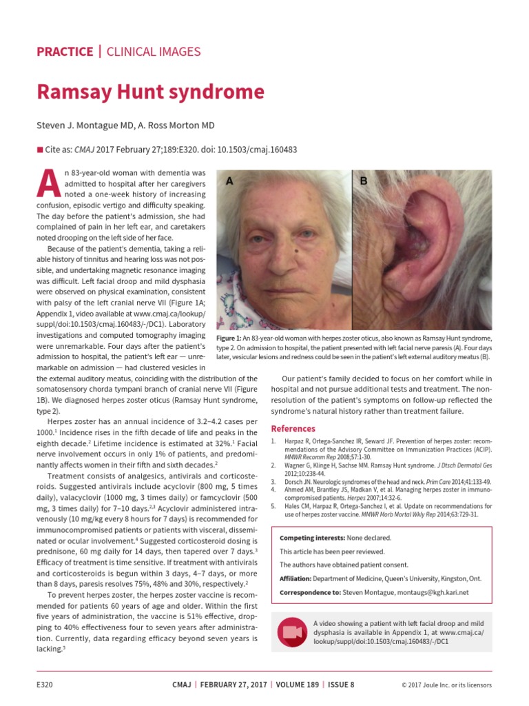 Ramsay Hunt Syndrome: Practice - Clinical Images | PDF | Herpes Simplex ...