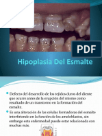 Hipoplasia Del Esmalte 3er Sem