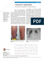 Cardiac Tamponade in Hypothyroidism