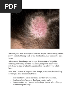 Angelica Delacruz 2 Shampoo Psoriasis