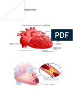 Jantung Koroner Anggie