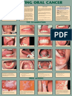 Detecting Oral Cancer