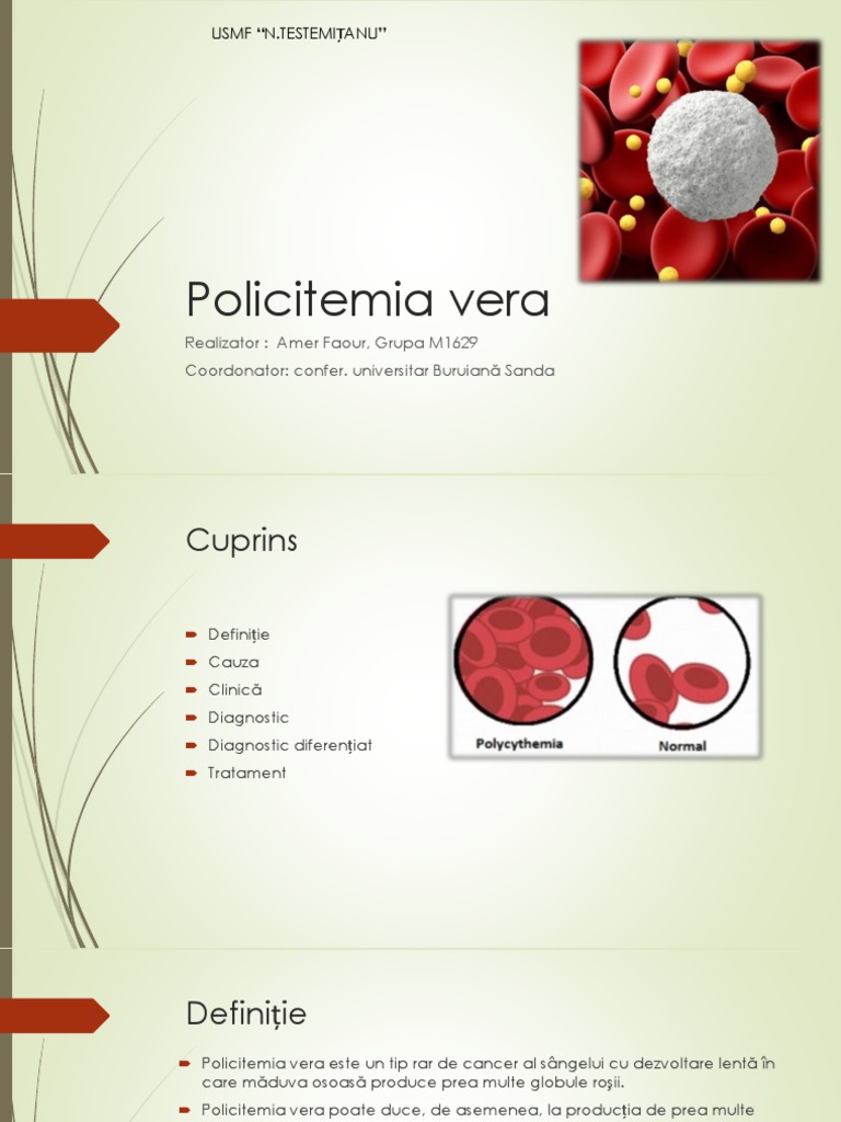 Policitemia Vera PDF