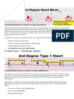 Understanding 1st, 2nd and 3rd Degree Heart Blocks