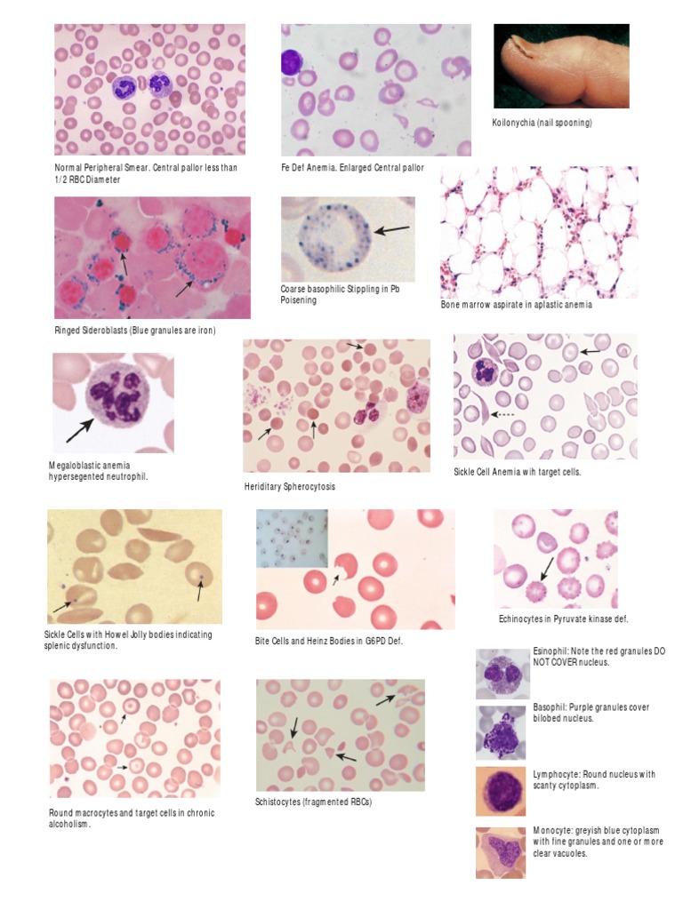 Hematology slides step 1 usmle Anemia Hematology