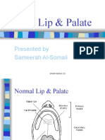 Cleft Lip & Palate: Presented by Sameerah Al-Somali