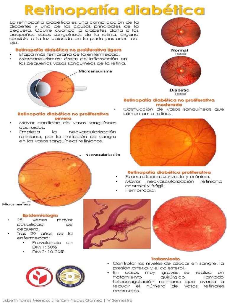 10 µb retina diabéteszes angiopátia