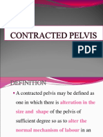 Contracted Pelviss Pres
