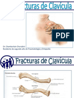 Fracturas de Clavícula