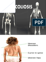 Scoliosis