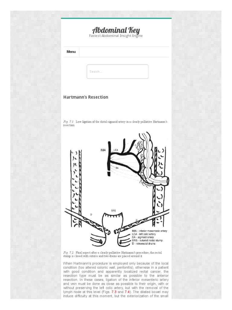 Hartmann's Resection Overview | PDF | Surgery | Gastroenterology