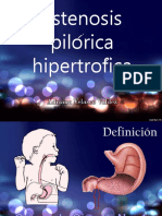 Estenosis pilórica hipertrófica