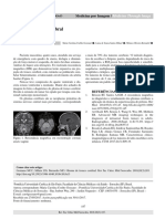 Glioma de Tronco Cerebral