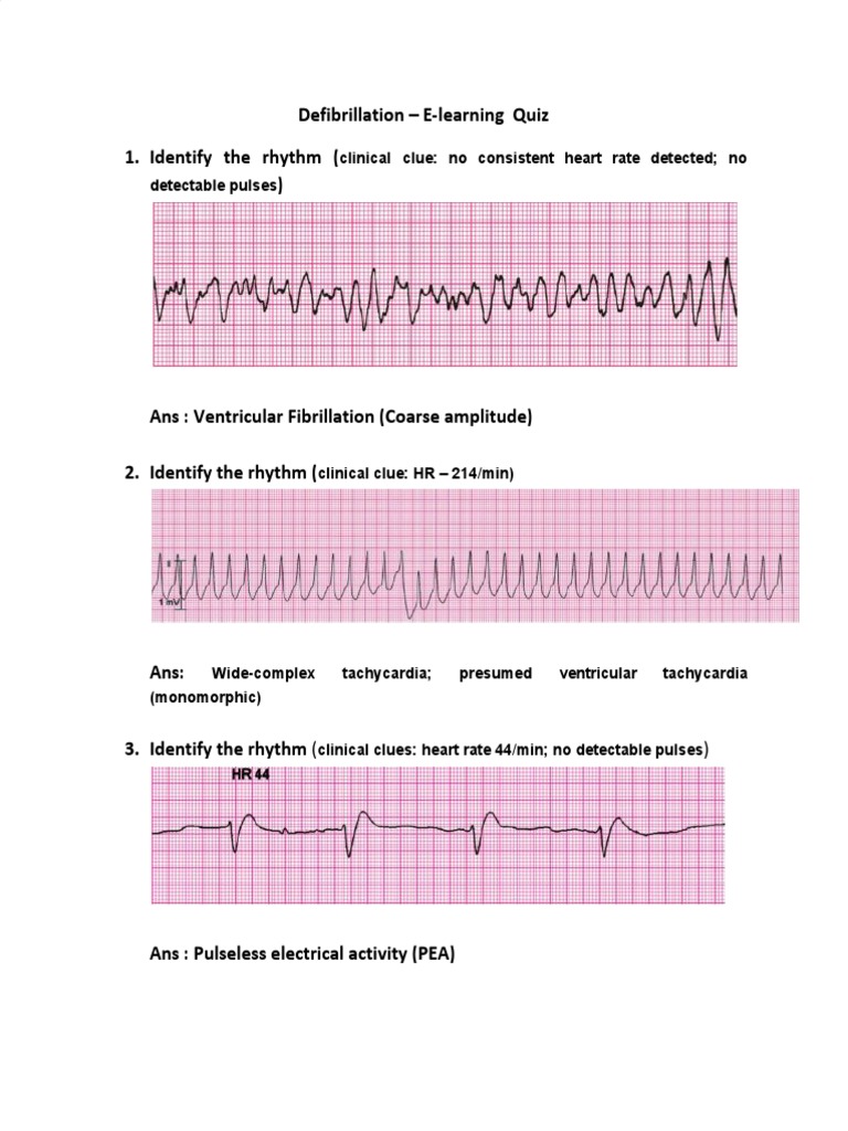 Defibrillation ELearning Quiz 1. Identify The Rhythm PDF