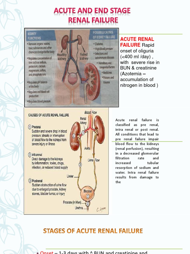 Acute Renal Failure Dialysis Hemodialysis