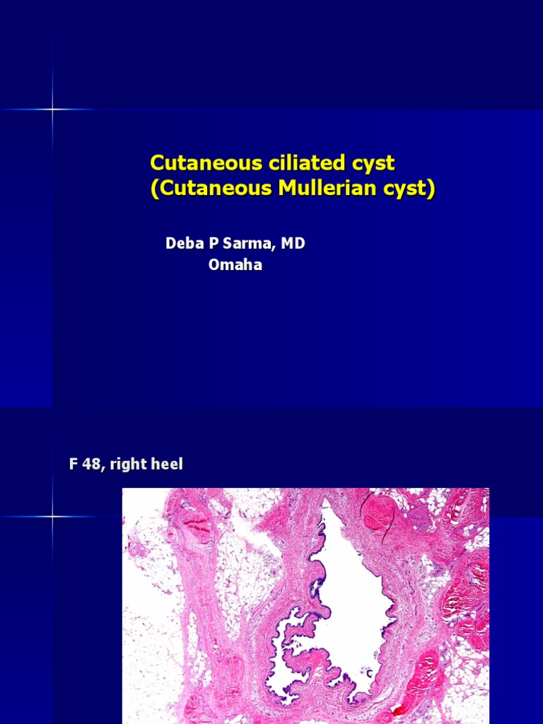 Cutaneous Ciliated Cyst (Cutaneous Mullerian Cyst), F 48, Right Heel | PDF