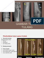 Tumor Tulang PPT Adx