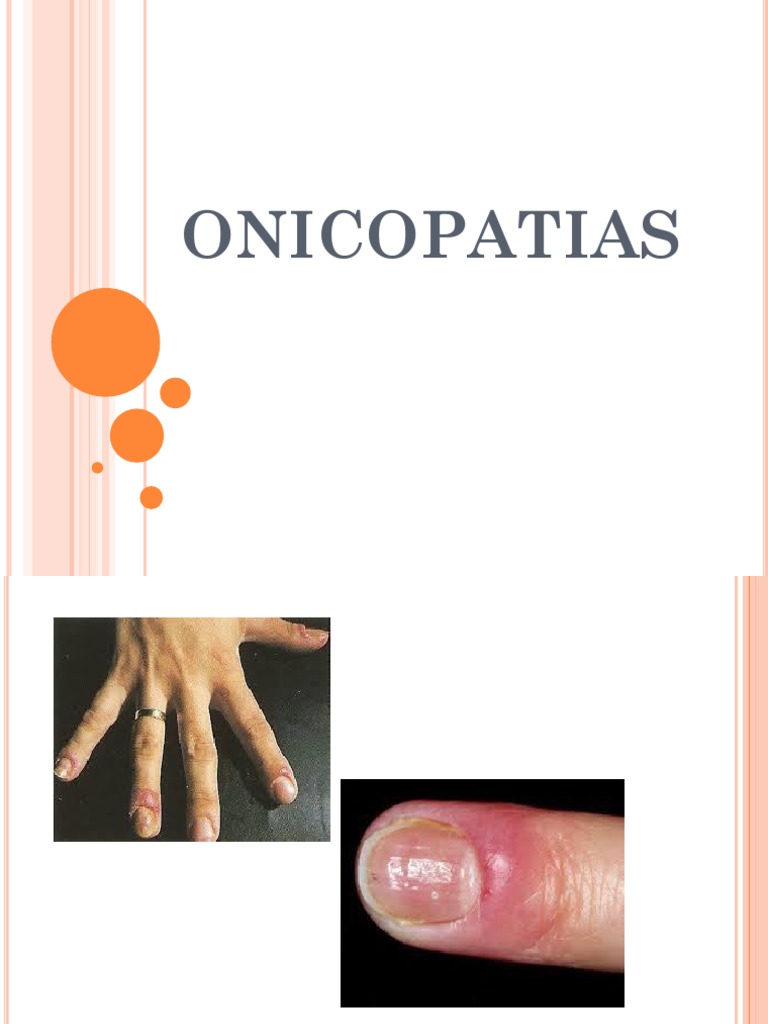 Onicopatias 1 PDF Clavo (anatomía) Especialidades Medicas