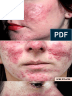 acne rosacea y vitiligo.pptx