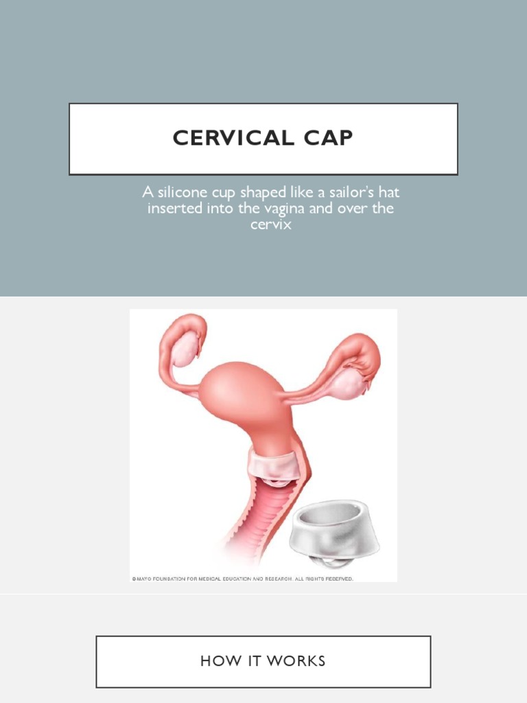Cervical Cap: A Silicone Cup Shaped Like A Sailor's Hat Inserted Into ...