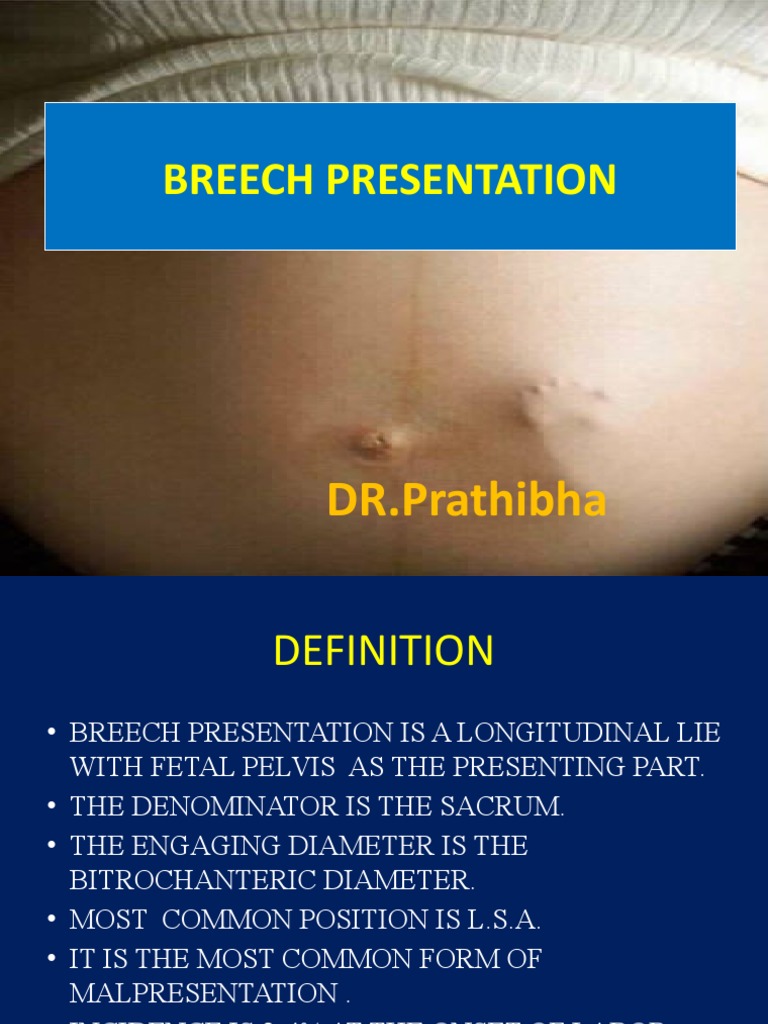 Breech presentation ppt image