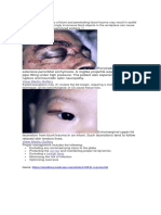 Eyelid Laceration