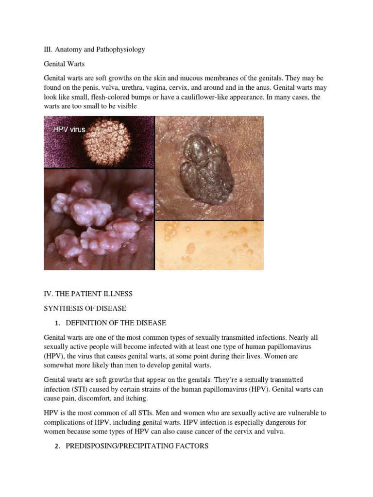 Penile (genital) warts and close-up view of human papilloma virus, computer  illustration. Warts (condyloma acuminata) of the anogenital region are cau  Stock Photo - Alamy, image size:768x1024