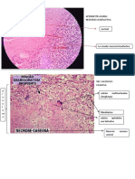 Apendicitis Aguda