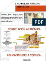 Tecnica Anestesica Nervio Alveolar Superior