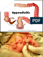 Appendicitis