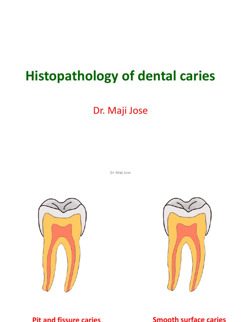 Caries Histopathology | PDF | Tooth Enamel | Dentin