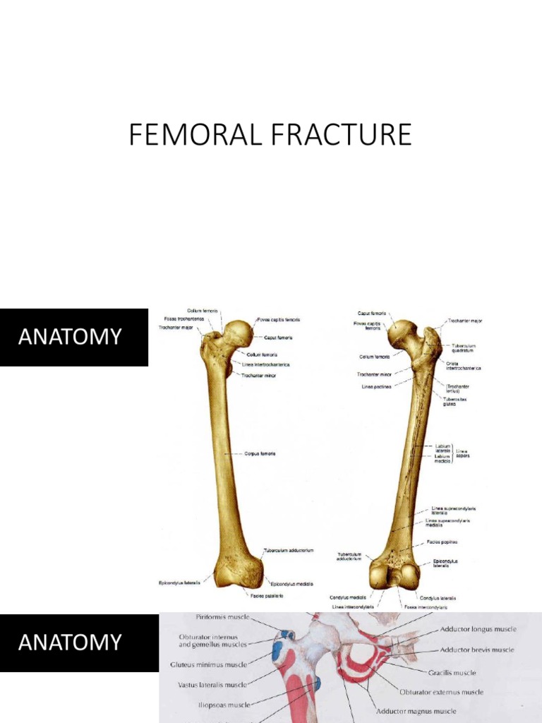 Understanding Femoral Fractures | PDF