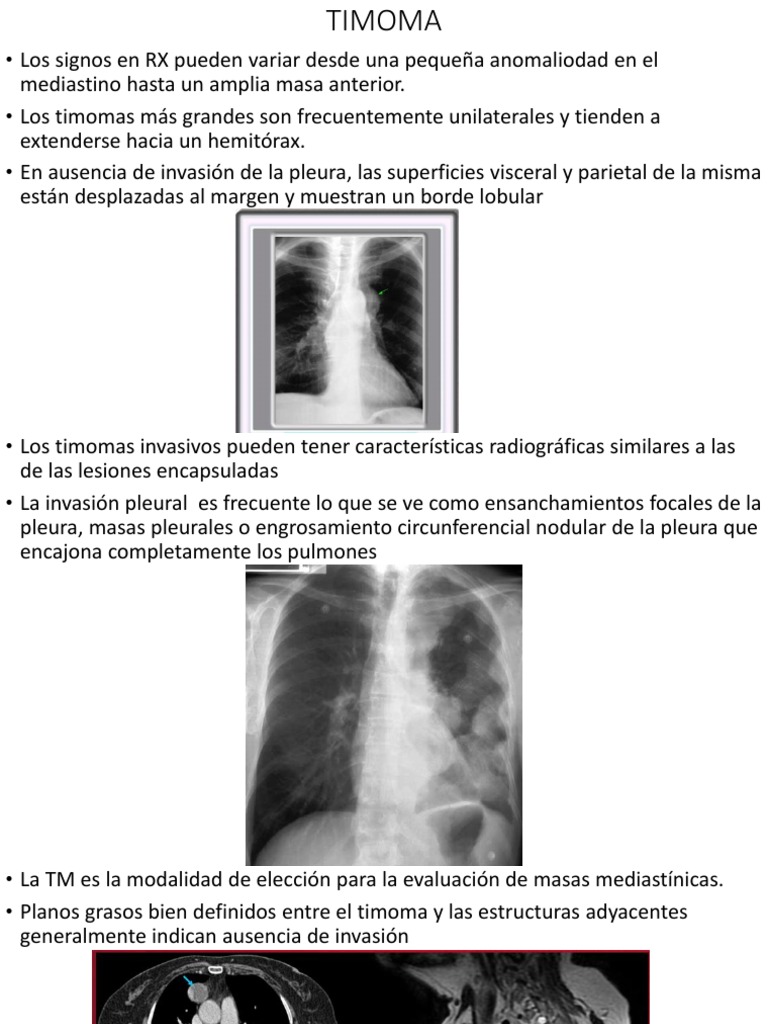 Diagnóstico Radiológico de Timomas | PDF