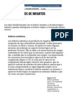 Tipos de Infartos.. Patologia