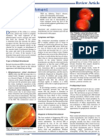 Retinal Detachment