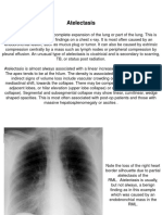 Lung Collapse Types and Signs on Chest X-Ray