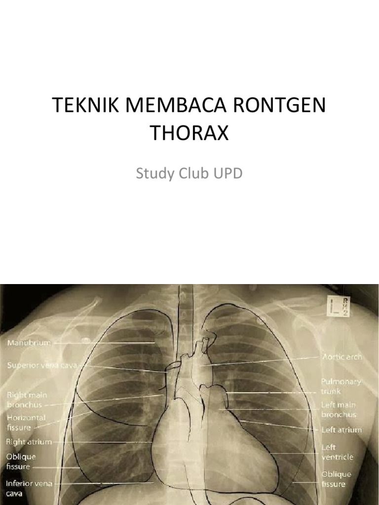 Teknik Membaca Rontgen Thorax | PDF