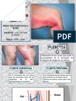 FLEBITIS