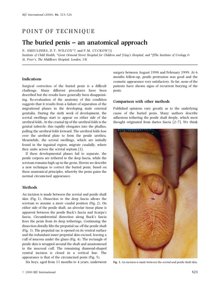 Kostuum Emulatie Geld rubber Buried Penis | PDF | Penis | Urology