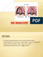 Tube Thoracostomy